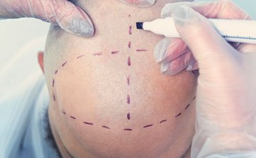 NIAA_scalp_micropigmentation_01360